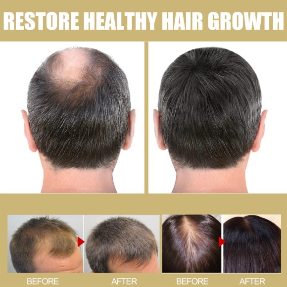 Houkea Dense Toupee Hair Repair Manic Thick Hairline Fixation Head Massage Care Heating Cap - Image 6