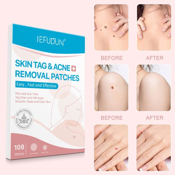 Acne Skin Tag Remover Beauty Acne Patch Wart Removal Stickers Removal Care Invisible Blackhead Skin Patch - Image 5